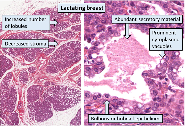 Schnittbild eines menschlichen Brustgewebes, das verschiedene Arten von Brustkrebs zeigt, mit laktierender Brust auf der linken Seite und reichhaltigem sekretorischem Material auf der rechten Seite.